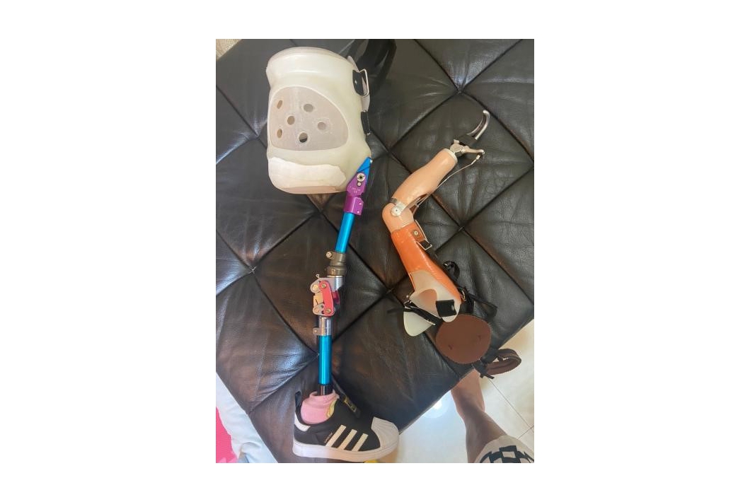 舊義肢(髖離斷義肢+肘上義肢)因長大而不合使用